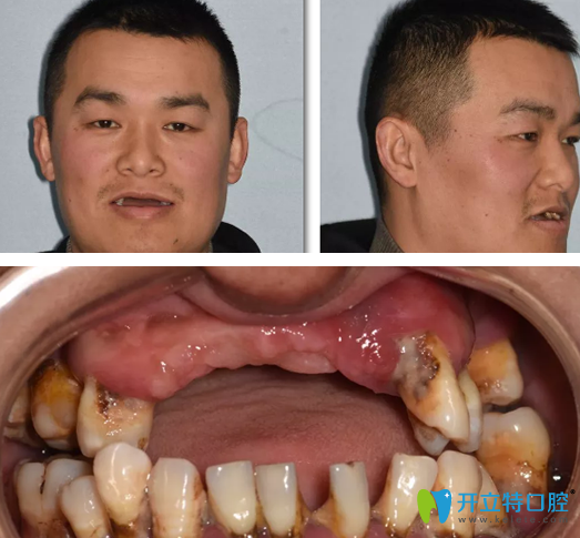 男子在重慶牙博士做即刻種植牙案例：術(shù)后即刻當(dāng)眾吃蘋(píng)果