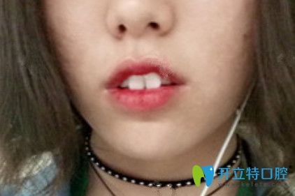在九江奇洋口腔做了牙齒矯正，我擺脫了“兔牙妹”稱號(hào)