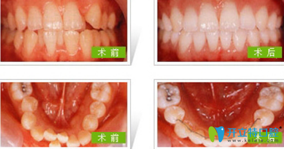 成人可以矯正牙齒嗎？成人牙齒矯正有哪些方法？