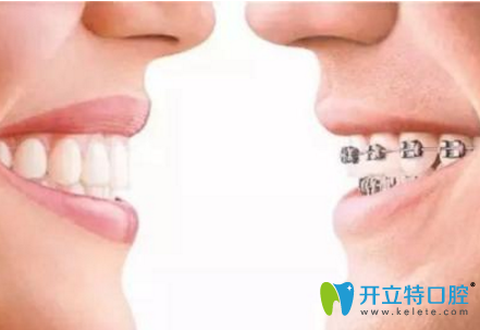 兒童用隱形牙套和傳統(tǒng)牙套哪個(gè)效果好？