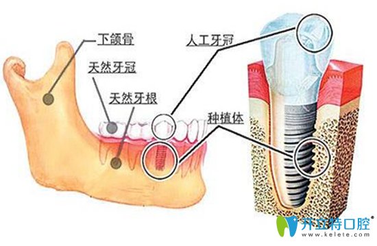 種植牙多少錢(qián)？哪些因素影響種植牙每一顆的價(jià)格？