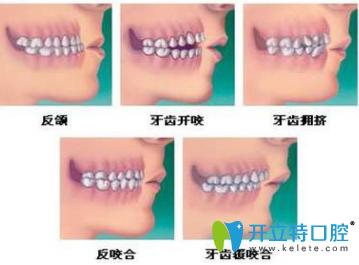 兒童矯正牙齒有哪幾個年齡段？有幾種矯牙齒的方法？