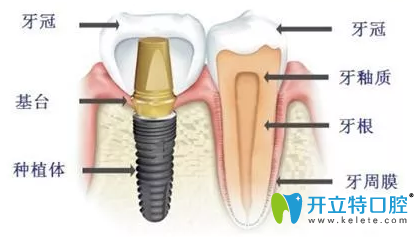 洛陽(yáng)維樂(lè)口腔門(mén)診部種植牙示意圖