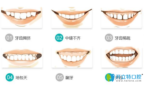 哪些情況牙齒需要矯正？牙齒矯正需要多少時(shí)間？