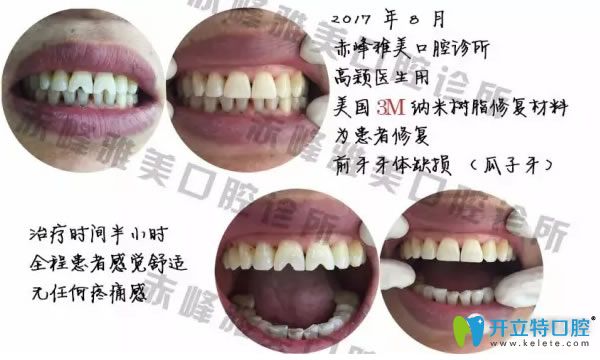 <!--<i data=20240703-sp></i>-->口腔牙齒修復(fù)案例