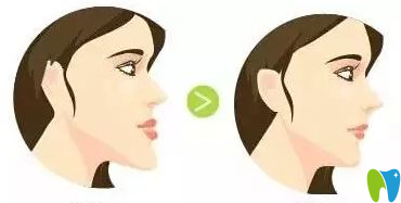 地包天如何預(yù)防？治療時(shí)間是什么時(shí)候？