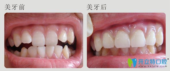 潮州眾信牙科美牙前后效果對比