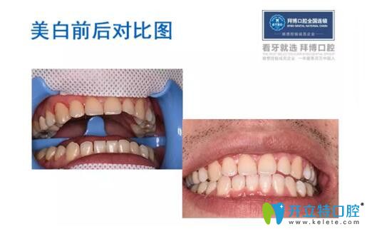 冷光美白牙齒前后對(duì)比