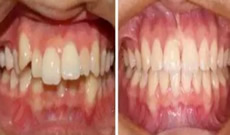 隱形矯正有用嗎？看自貢新橋口腔3D數(shù)碼隱形矯正案例效果