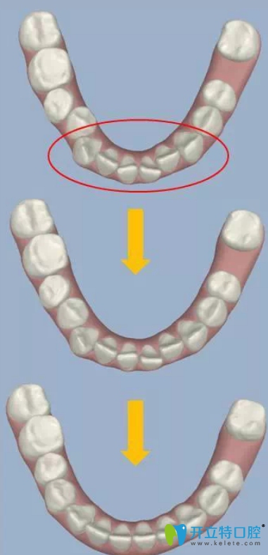 、醫(yī)師在3D數(shù)碼模型上模擬矯正療程