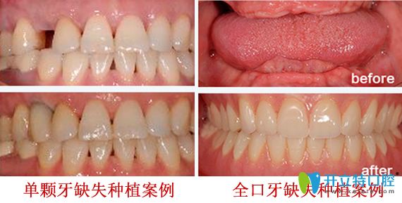 深圳拜博口腔好不好？深圳拜博口腔牙齒種植案例效果來證明實(shí)力