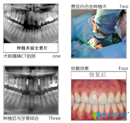 黎強(qiáng)給口牙缺失、牙槽骨萎縮幻陣采用德國費(fèi)亞丹種植技術(shù)種牙過程圖