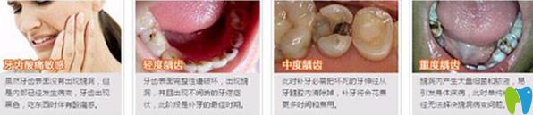 牙齒有個(gè)洞要補(bǔ)嗎 補(bǔ)牙的方式有哪些 補(bǔ)一顆牙價(jià)格多少錢(qián)