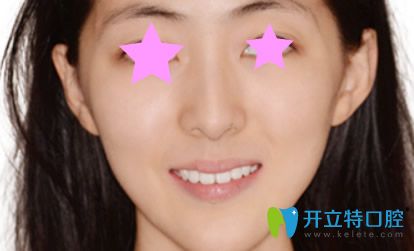 深圳同步齒科牙齒正畸半年后恢復(fù)效果