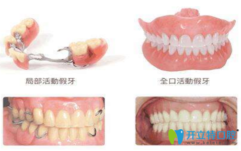 拔牙后鑲活動(dòng)假牙的時(shí)間