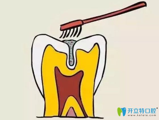 孩子幾歲做窩溝封閉合適？做完窩溝封閉后還會長蛀牙嗎？