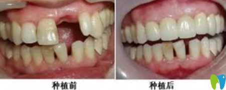 深圳蒙恩齒科即刻種植牙效果對比圖