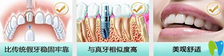 長(zhǎng)沙雅美口腔門診種植牙優(yōu)點(diǎn)介紹圖