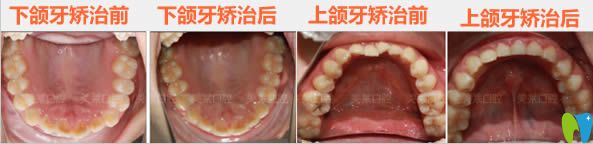 牙齒正畸后下頜牙和上頜牙的前后對(duì)比照