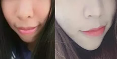 深圳牙齒矯正哪家好？看河山齒科齙牙妹正畸案例及對(duì)比圖