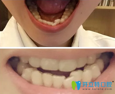 廣州拜博口腔怎么樣，28歲隱形牙齒矯正前后對(duì)比照片來(lái)揭曉