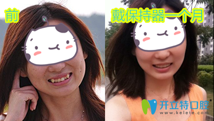 愛齒爾口腔牙齒矯正前后效果對(duì)比圖