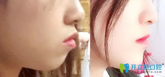 牙齒矯正能改變臉行嗎？看佳美口腔牙齒矯正前后對比照片知