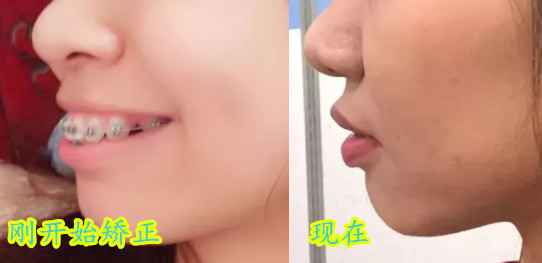 齙牙矯正多少錢?曬深圳弘和口腔花2.5萬(wàn)做齙牙矯正400天照