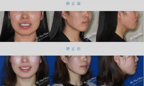 看26歲的小姜在上?？仆啐X科牙齒矯正案例 效果堪比整形哦