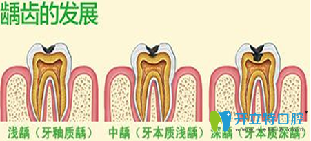 兒童齲齒怎么治療多少錢？齲齒治療預(yù)防方法及費(fèi)用大全