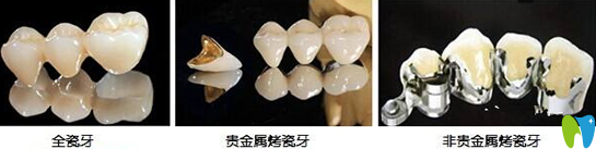 烤瓷牙哪種好多少錢一顆？分享烤瓷牙的種類和價格表