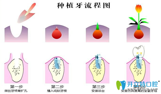 種植牙好不好？公布種植牙種類和2025全新價(jià)格表