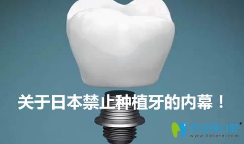 內(nèi)幕！日本為什么停止種植牙？禁止種植牙是真的嗎？