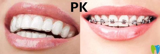 隱形矯正VS傳統(tǒng)牙套哪種效果？有什么區(qū)別呢？