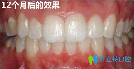 在<!--<i data=20240703-sp></i>-->馬瀧齒科做完隱適美牙齒矯正12個(gè)月的效果