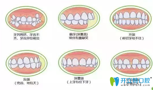 深度揭秘：在做牙齒矯正之前，你不得不了解的17個問題