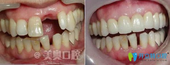 杭州美奧口腔單顆牙缺失種植牙前后對(duì)比圖