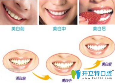 皓齒美白牙齒多少錢？解析步驟及優(yōu)缺點