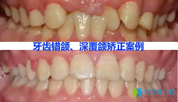 利爾口腔瀏陽(yáng)分院牙齒錯(cuò)頜畸形矯正效果