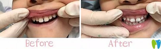 <!--<i data=20240703-sp></i>-->兒童口腔好不好？不妨看看孩子牙齒矯正案例效果