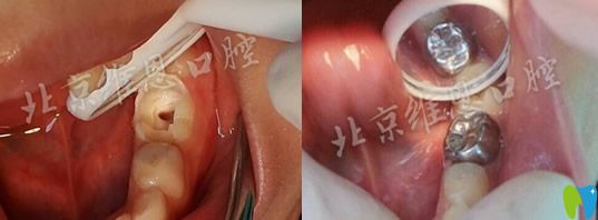 楊占娟乳牙齲壞做牙髓治療前后對(duì)比案例