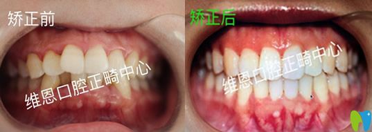 牙醫(yī)楊占娟怎么樣？看維恩口腔楊占娟真人案例