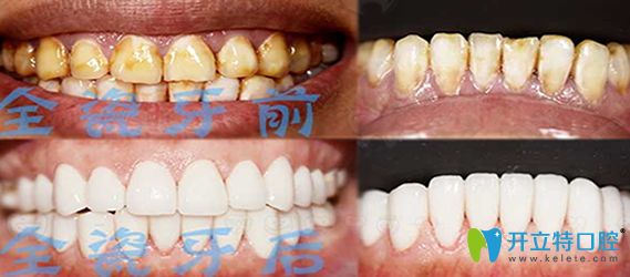 金圣口腔重度氟斑牙全瓷貼面修復(fù)案例