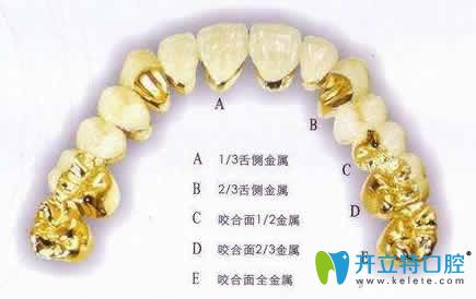 牙醫(yī)分享:套筒冠義齒怎樣收費(fèi)及價(jià)格是多少錢