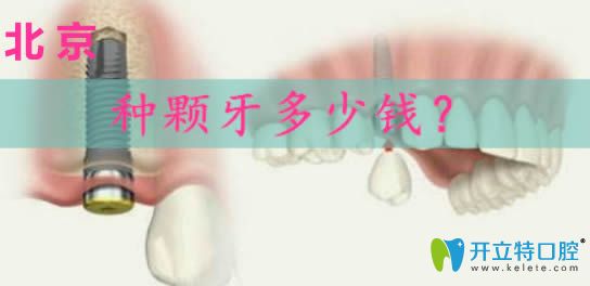 北京做種植牙多少錢?請看韓國奧齒泰和瑞士iti種植體價(jià)格表