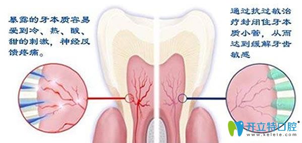 急性牙髓炎怎么治療搶先看 錯(cuò)過治療讓你后悔莫及