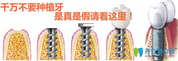 大家千萬(wàn)不要種植牙 如果非常后悔做了種牙請(qǐng)看這里的內(nèi)幕