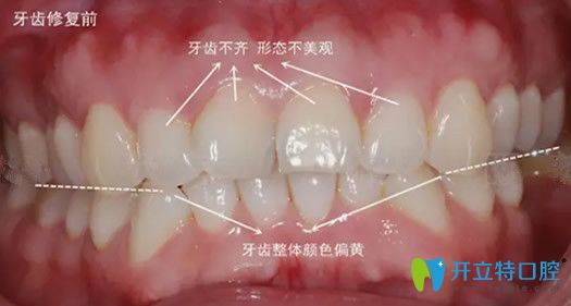 在嘉興曙光口腔做牙齒美容修復前