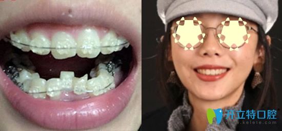  重慶整牙哪家？看重慶樂(lè)樂(lè)欣口腔牙齒矯正真人案例