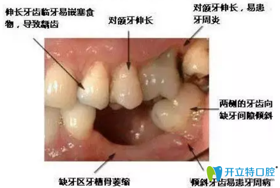 拔牙后鑲牙有沒有時(shí)間？